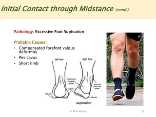 Dr M M Abedin 35
Initial Contact through Midstance (contd.)
Pathology: Excessive Foot Supination
Probable Causes:
• Compensated forefoot valgus
deformity
• Pes cavus
• Short limb
 