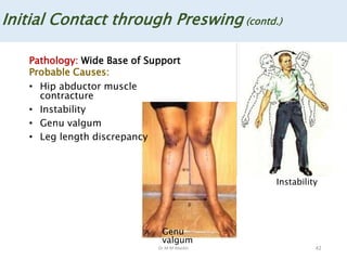 Dr M M Abedin 42
Initial Contact through Preswing (contd.)
Pathology: Wide Base of Support
Probable Causes:
• Hip abductor muscle
contracture
• Instability
• Genu valgum
• Leg length discrepancy
Instability
Genu
valgum
 