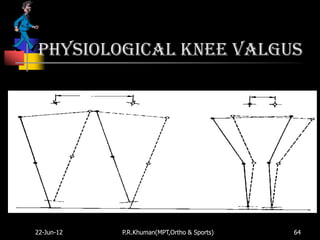 Physiological knee valgus




22-Jun-12   P.R.Khuman(MPT,Ortho & Sports)   64
 