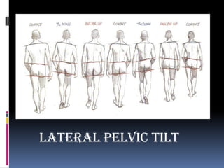 lateral pelvic tilt
 
