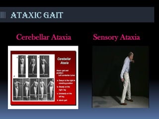 Ataxic gait
Cerebellar Ataxia Sensory Ataxia
 