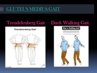 GLUTEUS MEDIUS GAIT
Trendelenberg Gait Duck Walking Gait
 