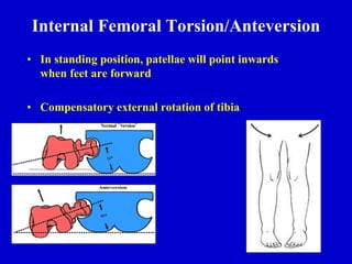 Internal Femoral Torsion/Anteversion
• In standing position, patellae will point inwards
when feet are forward
• Compensatory external rotation of tibia
 