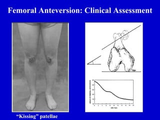 Femoral Anteversion: Clinical Assessment
“Kissing” patellae
 