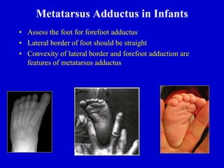 Metatarsus Adductus in Infants
• Assess the foot for forefoot adductus
• Lateral border of foot should be straight
• Convexity of lateral border and forefoot adduction are
features of metatarsus adductus
 