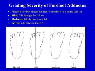 Grading Severity of Forefoot Adductus
• Project a line that bisects the heel. Normally it falls on the 2nd toe
• Mild: falls through the 3rd toe
• Moderate: falls between toes 3-4
• Severe: falls between toes 4-5
 