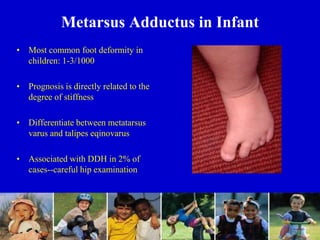 Metarsus Adductus in Infant
• Most common foot deformity in
children: 1-3/1000
• Prognosis is directly related to the
degree of stiffness
• Differentiate between metatarsus
varus and talipes eqinovarus
• Associated with DDH in 2% of
cases--careful hip examination
 