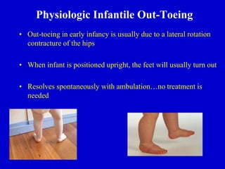 Physiologic Infantile Out-Toeing
• Out-toeing in early infancy is usually due to a lateral rotation
contracture of the hips
• When infant is positioned upright, the feet will usually turn out
• Resolves spontaneously with ambulation…no treatment is
needed
 