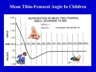Mean Tibio-Femoral Angle In Children
 