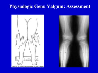 Physiologic Genu Valgum: Assessment
 