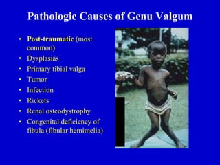 Pathologic Causes of Genu Valgum
• Post-traumatic (most
common)
• Dysplasias
• Primary tibial valga
• Tumor
• Infection
• Rickets
• Renal osteodystrophy
• Congenital deficiency of
fibula (fibular hemimelia)
 