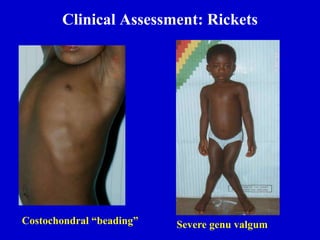 Clinical Assessment: Rickets
Costochondral “beading” Severe genu valgum
 