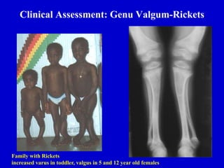 Clinical Assessment: Genu Valgum-Rickets
Family with Rickets
increased varus in toddler, valgus in 5 and 12 year old females
 