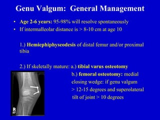Genu Valgum: General Management
• Age 2-6 years: 95-98% will resolve spontaneously
• If intermalleolar distance is > 8-10 cm at age 10
1.) Hemiephiphyseodesis of distal femur and/or proximal
tibia
2.) If skeletally mature: a.) tibial varus osteotomy
b.) femoral osteotomy: medial
closing wedge: if genu valgum
> 12-15 degrees and superolateral
tilt of joint > 10 degrees
 