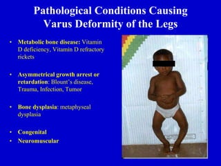 Pathological Conditions Causing
Varus Deformity of the Legs
• Metabolic bone disease: Vitamin
D deficiency, Vitamin D refractory
rickets
• Asymmetrical growth arrest or
retardation: Blount’s disease,
Trauma, Infection, Tumor
• Bone dysplasia: metaphyseal
dysplasia
• Congenital
• Neuromuscular
 