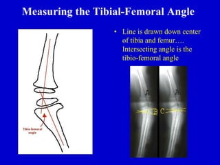 Measuring the Tibial-Femoral Angle
• Line is drawn down center
of tibia and femur….
Intersecting angle is the
tibio-femoral angle
 