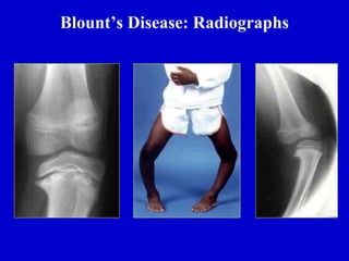 Blount’s Disease: Radiographs
 