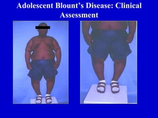 Adolescent Blount’s Disease: Clinical
Assessment
 