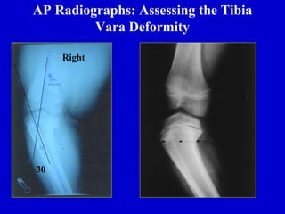AP Radiographs: Assessing the Tibia
Vara Deformity
Right
30
Left
26
 
