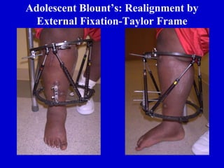 Adolescent Blount’s: Realignment by
External Fixation-Taylor Frame
 