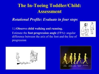 The In-Toeing Toddler/Child:
Assessment
Rotational Profile: Evaluate in four steps
1.) Observe child walking and running.
Estimate the foot progression angle (FPA): angular
difference between the axis of the foot and the line of
progression
 
