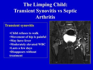 The Limping Child:
Transient Synovitis vs Septic
Arthritis
Transient synovitis
•Child refuses to walk
•Movement of hip is painful
•May have fever
•Moderately elevated WBC
•Lasts a few days
•Disappears without
treatment
 