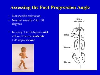 Assessing the Foot Progression Angle
• Nonspecific estimation
• Normal: usually -5 tp +20
degrees
• In-toeing -5 to-10 degrees: mild
-10 to -15 degrees moderate
>-15 degrees severe
 