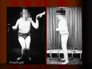 Crouch gait Jump gait
 