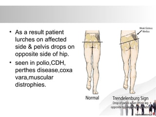 • As a result patient
lurches on affected
side & pelvis drops on
opposite side of hip.
• seen in polio,CDH,
perthes disease,coxa
vara,muscular
distrophies.
 