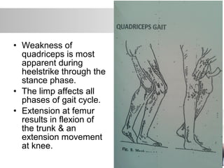 • Weakness of
quadriceps is most
apparent during
heelstrike through the
stance phase.
• The limp affects all
phases of gait cycle.
• Extension at femur
results in flexion of
the trunk & an
extension movement
at knee.
 