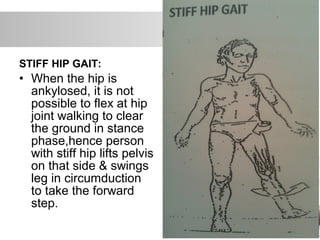 STIFF HIP GAIT:
• When the hip is
ankylosed, it is not
possible to flex at hip
joint walking to clear
the ground in stance
phase,hence person
with stiff hip lifts pelvis
on that side & swings
leg in circumduction
to take the forward
step.
 