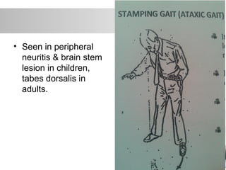 • Seen in peripheral
neuritis & brain stem
lesion in children,
tabes dorsalis in
adults.
 