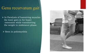 Genu recurvatum gait
 In Paralysis of hamstring muscles
the knee goes in for hyper
-extension while transmitting
the weight in midstance phase.
 Seen in poliomyelitis
 