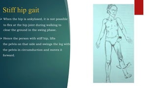 Stiff hip gait
 When the hip is ankylosed, it is not possible
to flex at the hip joint during walking to
clear the ground in the swing phase.
 Hence the person with stiff hip, lifts
the pelvis on that side and swings the leg with
the pelvis in circumduction and moves it
forward.
 