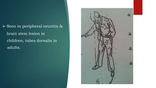  Seen in peripheral neuritis &
brain stem lesion in
children, tabes dorsalis in
adults.
 