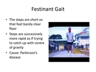 Festinating GAIT and it abnormality by Dr Umar Mohammed NOHIL | PPTX