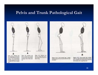 Pelvis and Trunk Pathological Gait
88
 