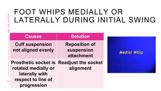 FOOT WHIPS MEDIALLY OR
LATERALLY DURING INITIAL SWING
Causes Solution
Cuff suspension
not aligned evenly
Reposition of
suspension
attachment
Prosthetic socket is
rotated medially or
laterally with
respect to line of
progression
Readjust the socket
alignment
3 6
DR.
JOE
ANTONY
 