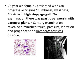 • 26 year old female , presented with C/0
progressive tingling/ numbness, weakness,
Ataxia with high steppage gait. On
examination there was spastic parapersis with
extensor plantar. Sensory examination
revealed diminished touch, pressure, vibration
and proprioception.Rombergs test was
positive.
 