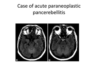 Case of acute paraneoplastic
pancerebellitis
 