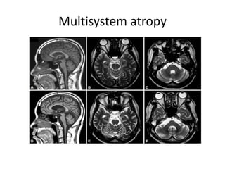 Multisystem atropy
 