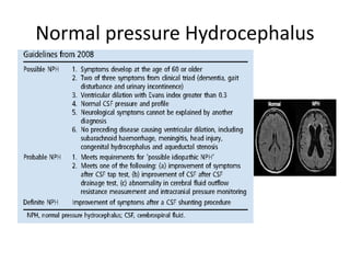Normal pressure Hydrocephalus
 