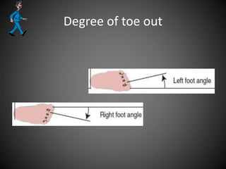 Degree of toe out
 