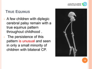 TRUE EQUINUS
• A few children with diplegic
cerebral palsy remain with a
true equinus pattern
throughout childhood .
• The persistence of this
pattern is unusual and seen
in only a small minority of
children with bilateral CP.
18
GaitAbnormalitiesinCP
 