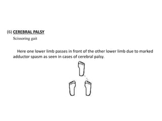 (6) CEREBRAL PALSY
Scissoring gait
Here one lower limb passes in front of the other lower limb due to marked
adductor spasm as seen in cases of cerebral palsy.
 