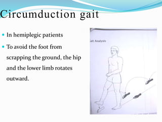 Circumduction gait
 In hemiplegic patients
 To avoid the foot from
scrapping the ground, the hip
and the lower limb rotates
outward.
 