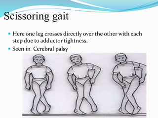 Scissoring gait
 Here one leg crosses directly over the other with each
step due to adductor tightness.
 Seen in Cerebral palsy
 