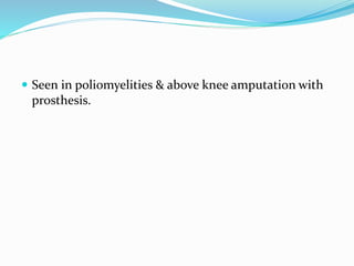  Seen in poliomyelities & above knee amputation with
prosthesis.
 