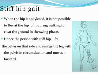 Stiff hip gait
 When the hip is ankylosed, it is not possible
to flex at the hip joint during walking to
clear the ground in the swing phase.
 Hence the person with stiff hip, lifts
the pelvis on that side and swings the leg with
the pelvis in circumduction and moves it
forward.
 