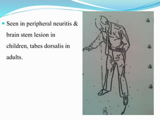  Seen in peripheral neuritis &
brain stem lesion in
children, tabes dorsalis in
adults.
 